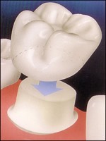 dental crown1
