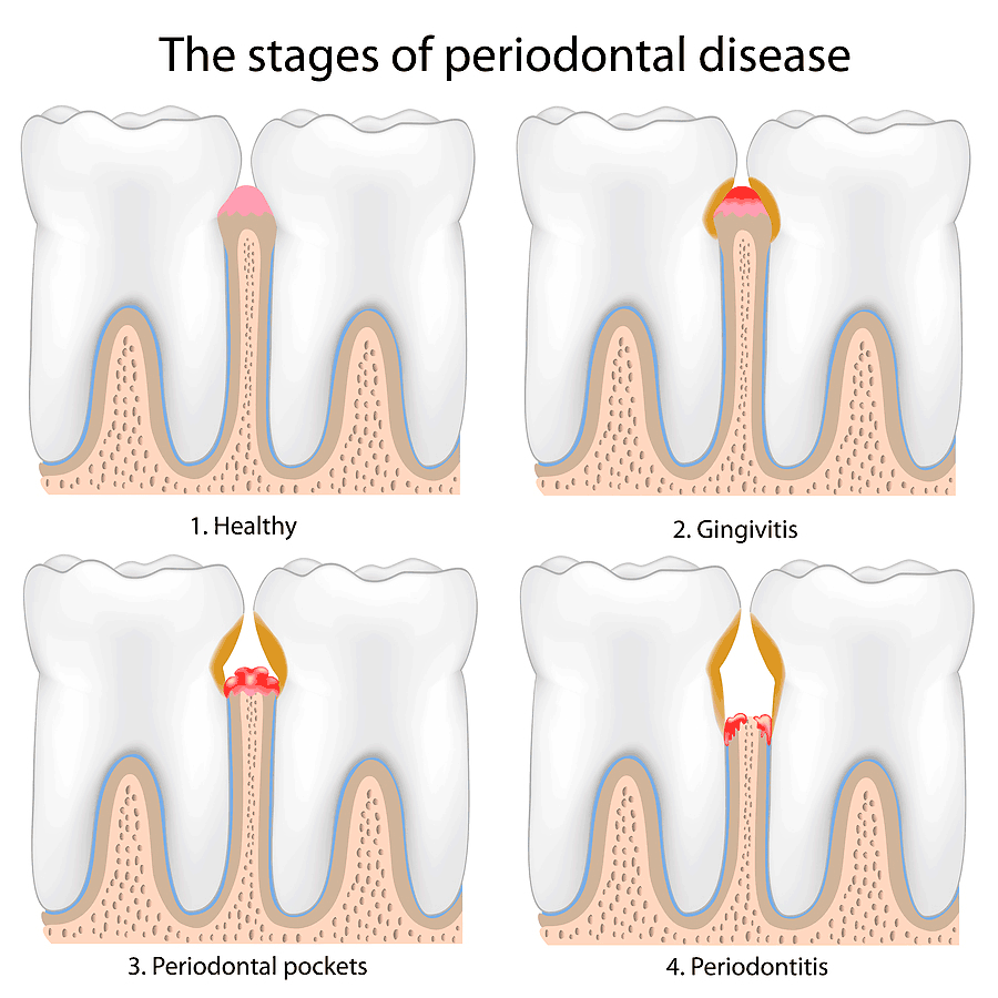 gum-disease