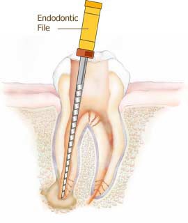 rootcanal2-2