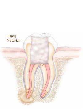 rootcanal4