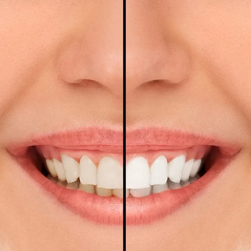 gingivitis (the more common form) can affect up to 80 per cent of the population