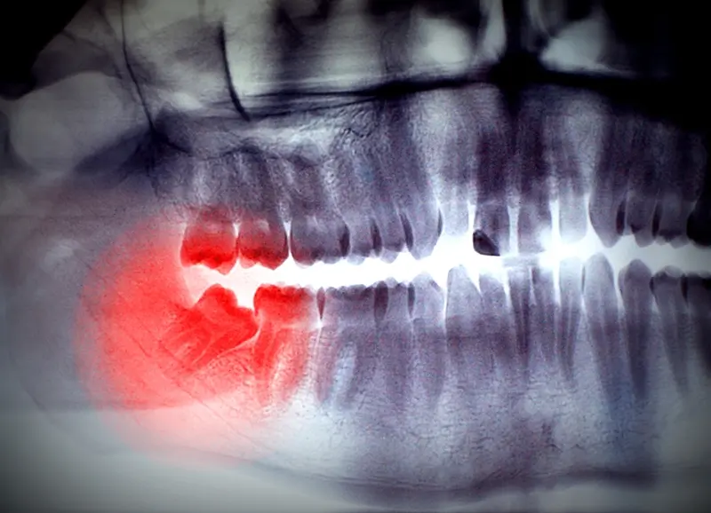 Impacted wisdom teeth can cause a great number of complications.