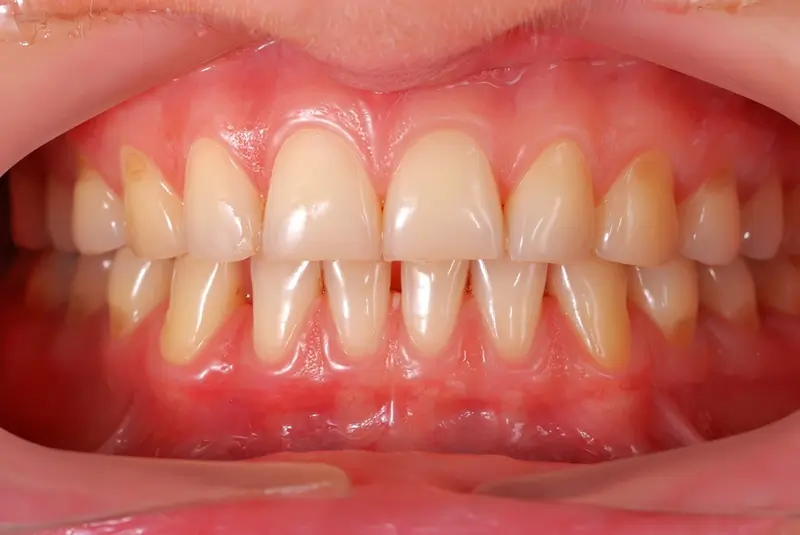 Further complications such as periodontitis can arise if gingivitis is left unchecked.