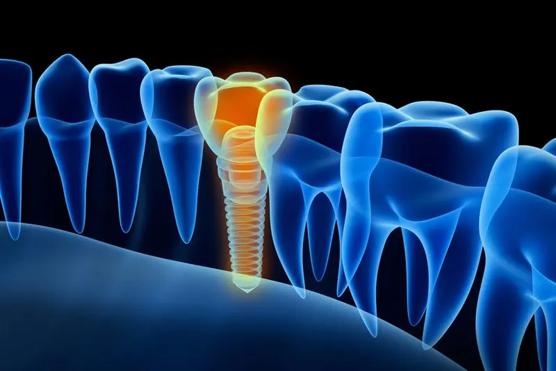 X-ray view of teeth