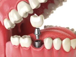 It's essential to protect your new dental implant.