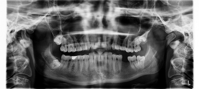 x ray, wisdom teeth